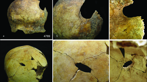 Ossos com marcas de violência extrema - Foto: SCHULTING ET AL. ANTIQUITY, DEZEMBRO DE 2024