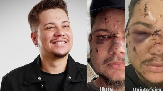 Sertanejo é agredido em show, leva 30 pontos e fica com o rosto desfigurado - Reprodução / Instagram