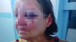 A mulher sofreu lesões graves com traumas no crânio e na face | Foto: Cortesia/ Ascom PC