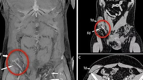 Foto: Reprodução/BMJ Case Reports