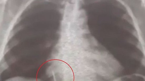 Imagem Broca de dentista se solta durante atendimento e vai parar dentro de pulmão de paciente no RN