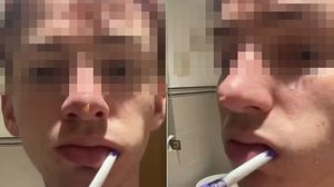 Um jovem da Inglaterra mostrou nas redes sociais o momento em que um fluido começa a vazar de seu nariz após realizar um procedimento de ''rinoplastia líquida'' | Reprodução / TikTok