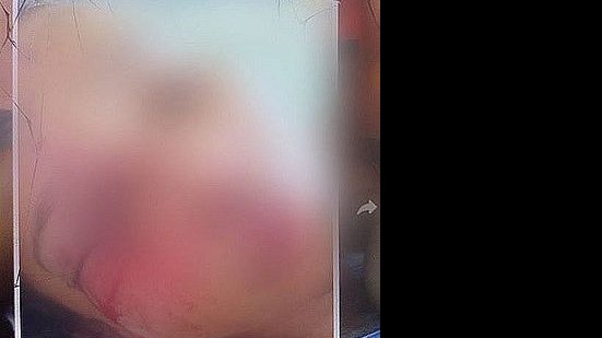 Imagem Mulher que teve corpo queimado por companheiro recebe alta médica em Maceió