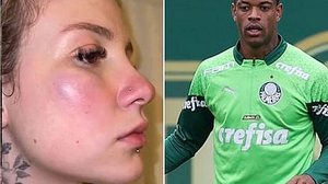 Ana Clara mostra hematomas e denuncia o jogador Caio Paulista | Montagem