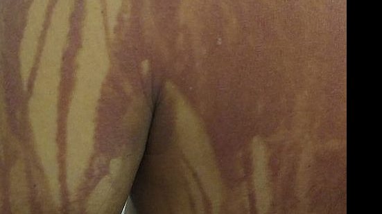 Vítima ficou com marcas pelo corpo | Reprodução / Correio 24h