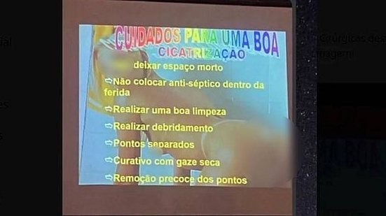 Imagem de mulher nua em posição sensual utilizada por médico na palestra em Maceió. O TNH1 editou a imagem e borrou o rosto e as partes íntimas da mulher | Reprodução / Redes sociais