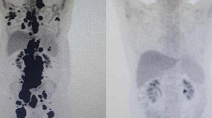 Imagem Anvisa autoriza pesquisa clínica de medicamento contra leucemia e linfoma