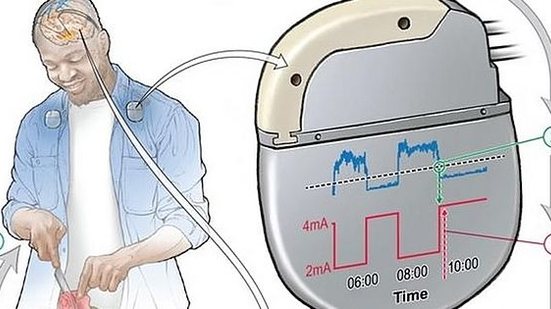 Estudo mostra melhora de sintomas de Parkinson em pacientes com 'marcapasso' cerebral | Divulgação / Laboratório Phillp Starr