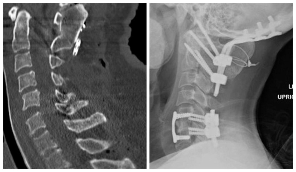 Dissocia&amp;ccedil;&amp;atilde;o craniocervical relatada pelo International Journal of Spine Surgery. &amp;mdash; Foto: International Journal of Spine Surgery/Divulga&amp;ccedil;&amp;atilde;o